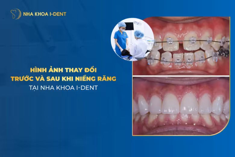 hình ảnh niềng răng