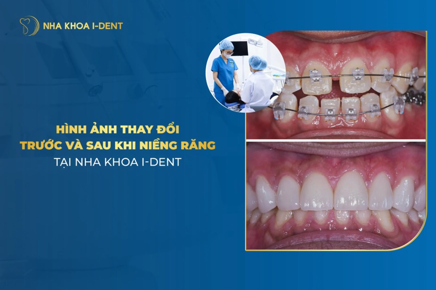 Hình ảnh niềng răng: Sự thay đổi trước và sau khi niềng răng tại I-Dent