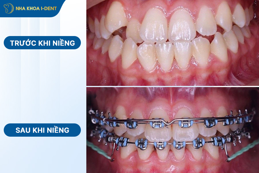 hình ảnh răng đẹp nhất