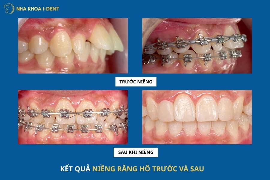 kết quả niềng răng trước và sau khi niềng răng hô