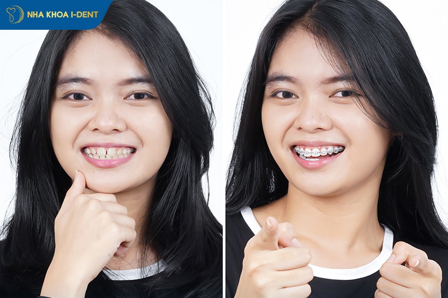 niềng răng mắc cài sứ và kim loại