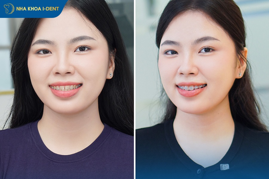 niềng răng mắc cài sứ và kim loại