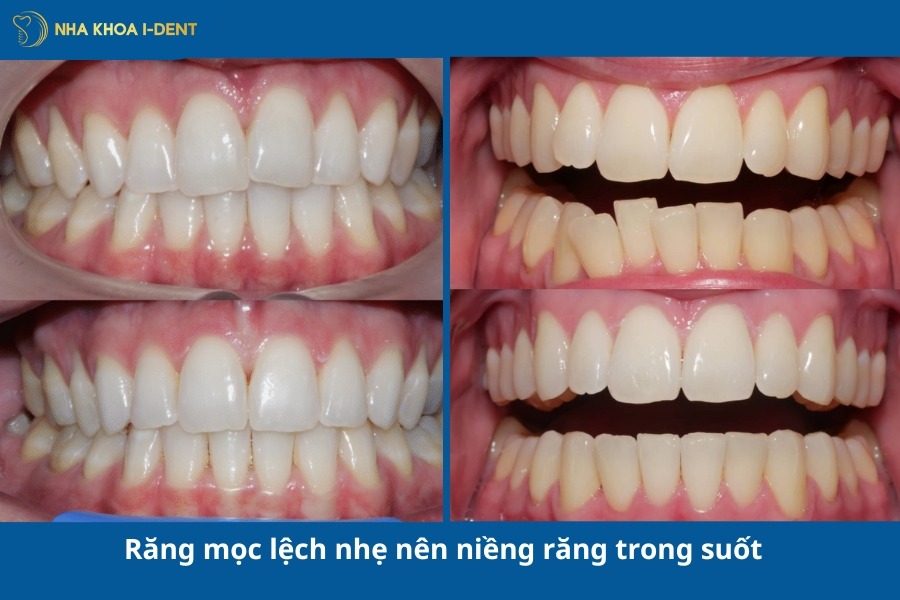 khi nào nên niềng răng trong suốt