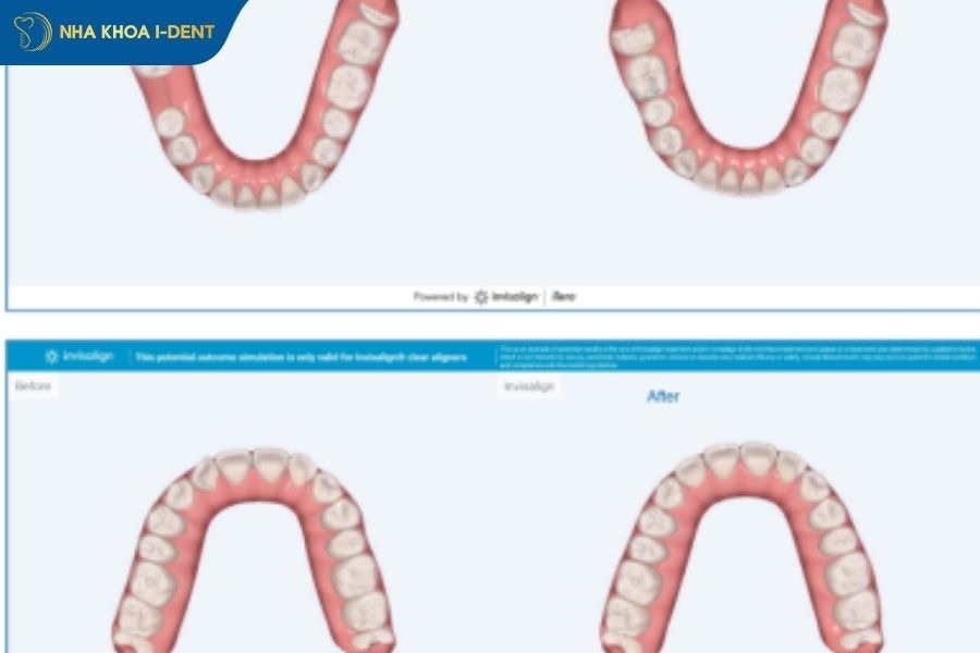 Lập kế hoạch di chuyển răng theo giai đoạn