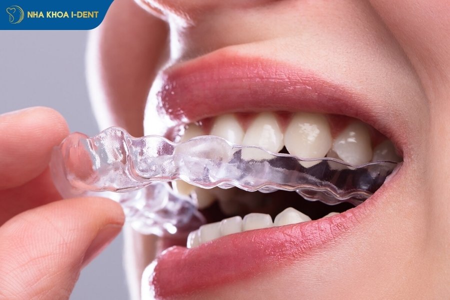 Loại khí cụ niềng răng ảnh hướng đến giá niềng răng