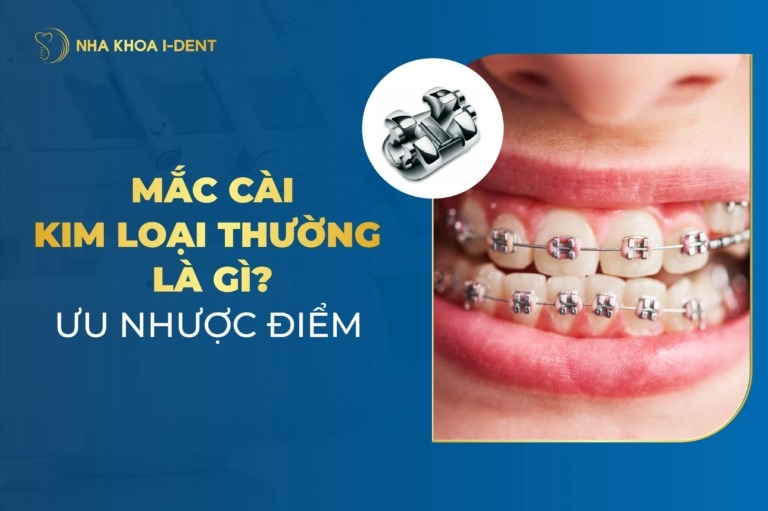 Mắc Cài Kim Loại Thường Là Gì? Ưu Nhược Điểm