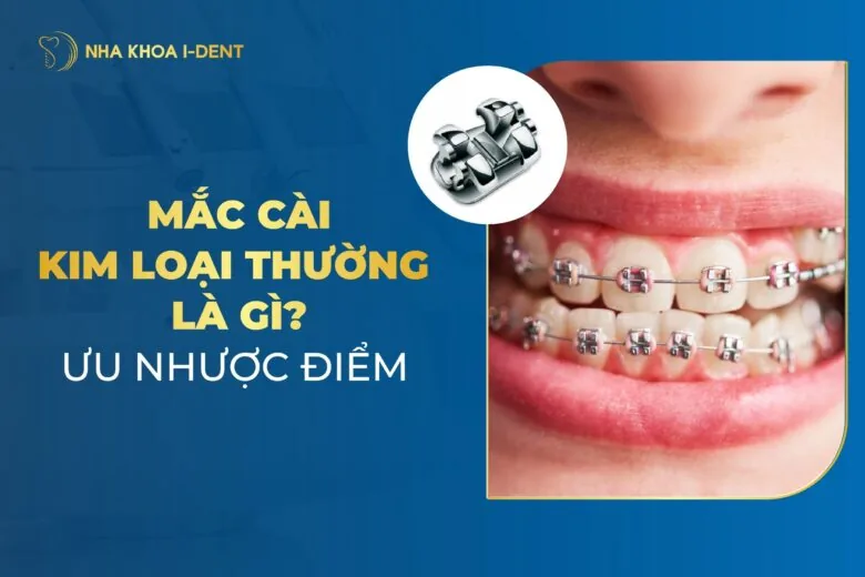 Mắc Cài Kim Loại Thường Là Gì? Ưu Nhược Điểm