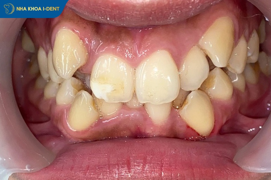 mắc cài kim loại thường và tự buộc