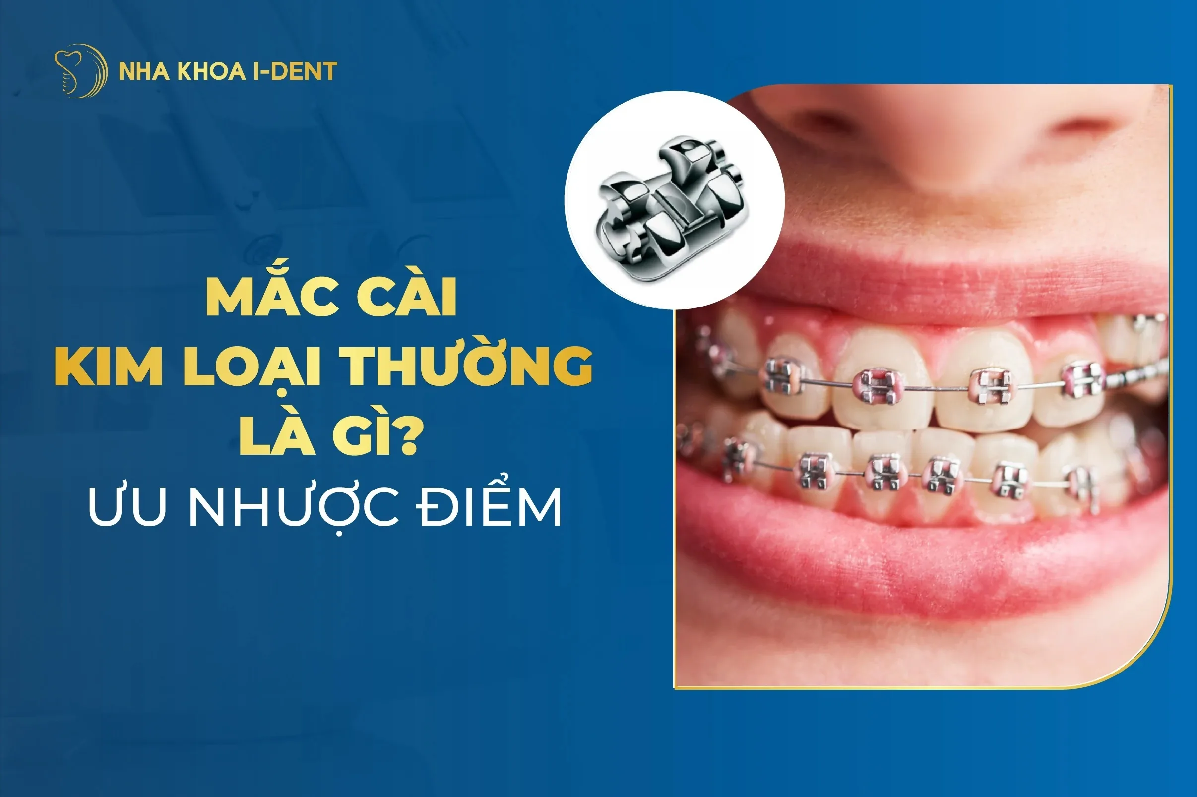 Mắc Cài Kim Loại Thường Là Gì? Ưu Nhược Điểm