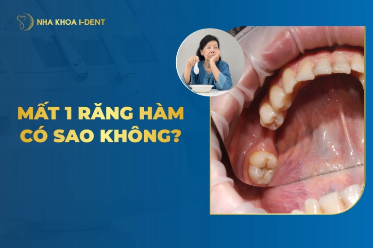 Mất 1 Răng Hàm Có Sao Không? Hậu Quả Và Cách Khắc Phục