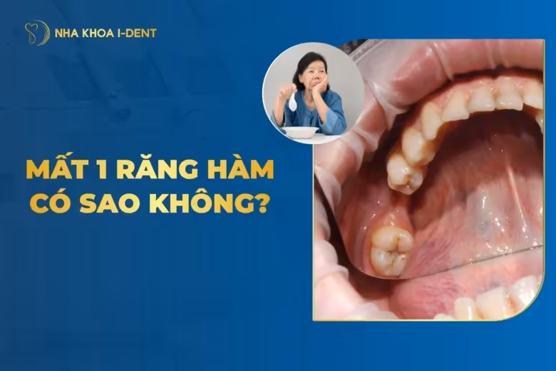 Mất 1 Răng Hàm Có Sao Không? Hậu Quả Và Cách Khắc Phục
