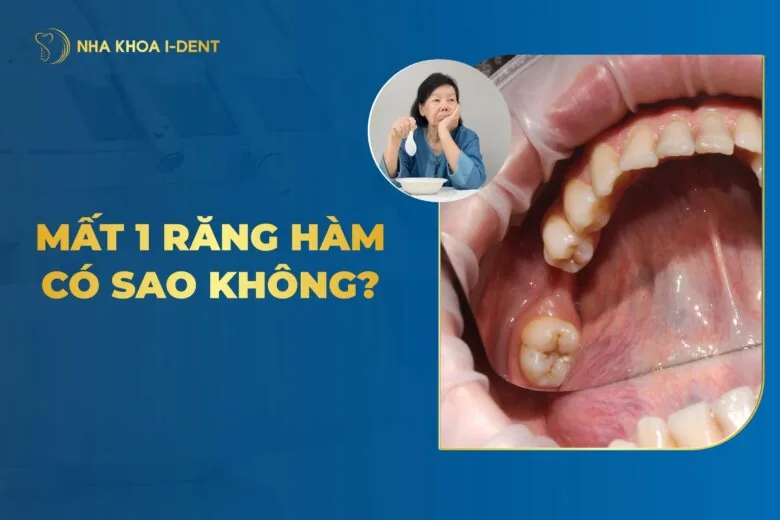 Mất 1 Răng Hàm Có Sao Không? Hậu Quả Và Cách Khắc Phục