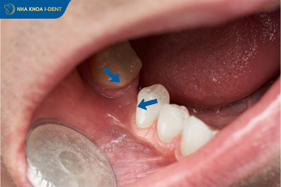 mất răng hàm trên có sao không