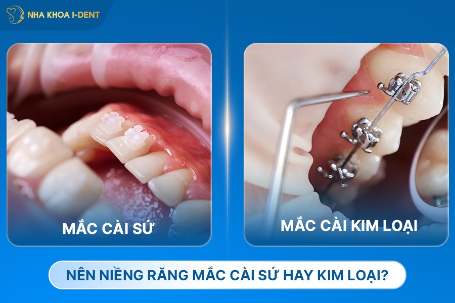 Nên niềng răng mắc cài sứ hay kim loại