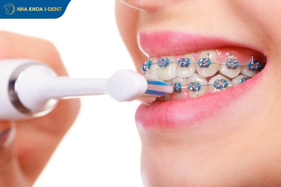 nguyên nhân gây tác hại niềng răng