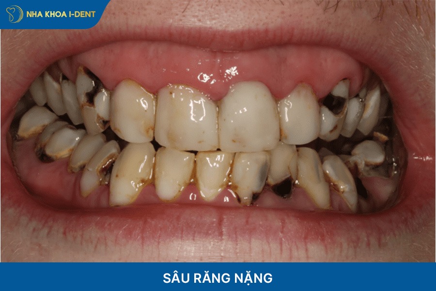 Răng sâu hoặc hư tủy nặng sẽ phải nhổ để tránh nguy hiểm khi niềng trong suốt