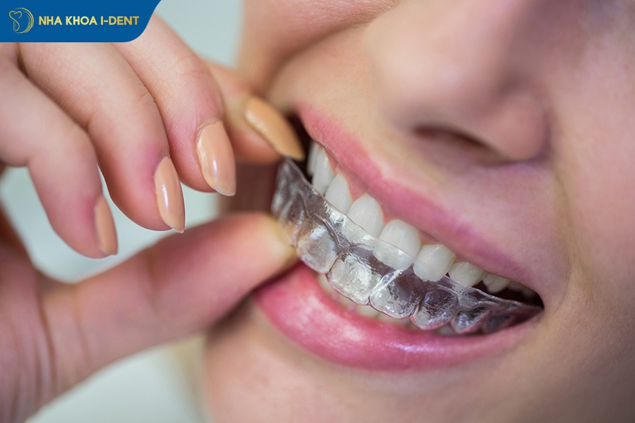 niềng răng 3d clear là gì