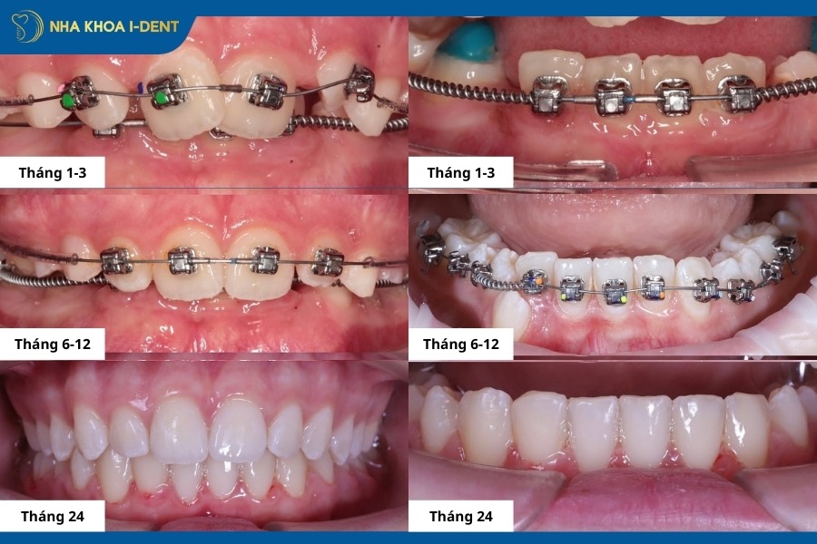 niềng răng bao lâu thì có kết quả
