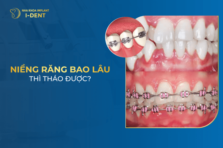 Niềng Răng Mất Khoảng Bao Lâu Thì Tháo Được?