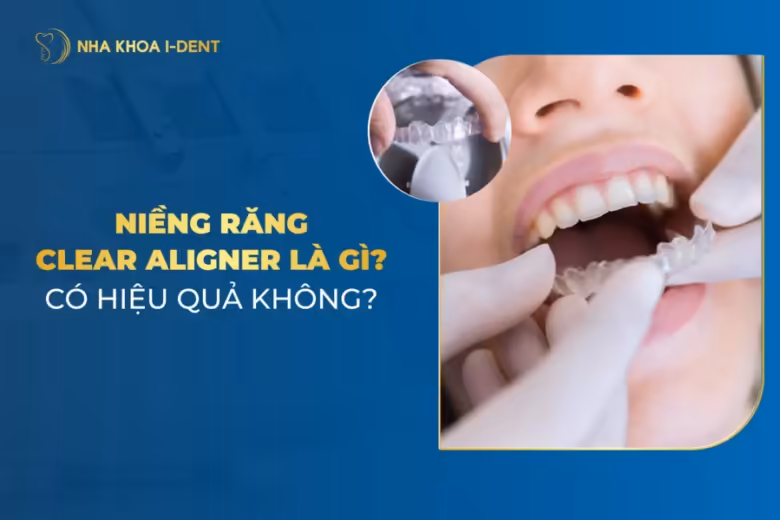 niềng răng clear aligner