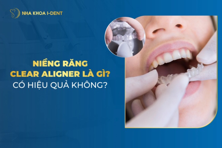 Niềng răng Clear Aligner là gì? Có hiệu quả không?