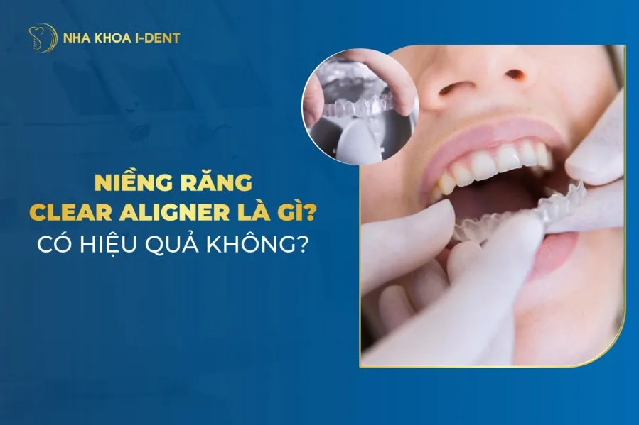 niềng răng clear aligner