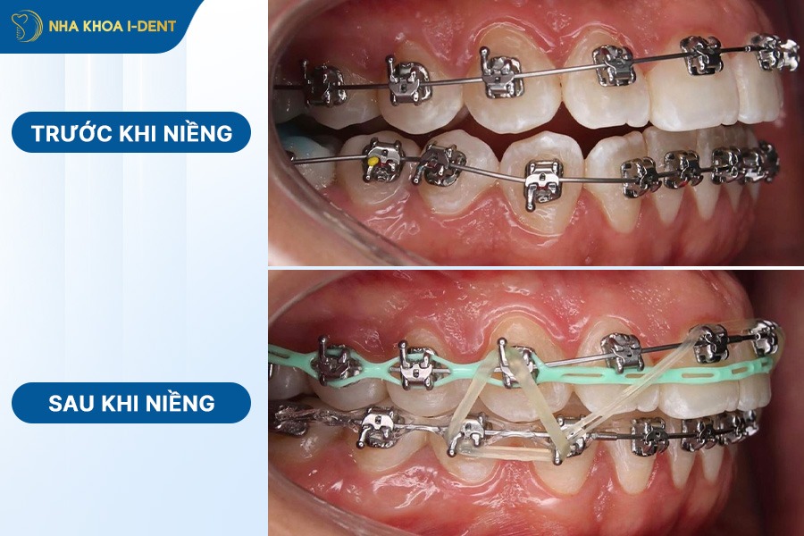 niềng răng hô trước và sau