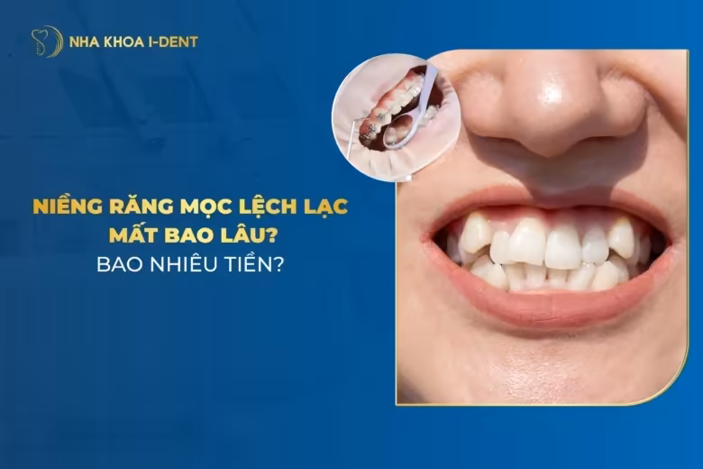 Niềng Răng Mọc Lệch Lạc Bao Lâu? Giá Bao Nhiêu?