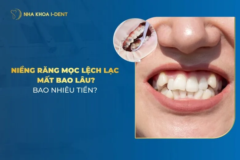 Niềng Răng Mọc Lệch Lạc Bao Lâu? Giá Bao Nhiêu?