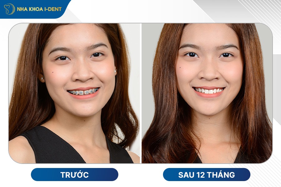 niềng răng lệch lạc mất bao lâu