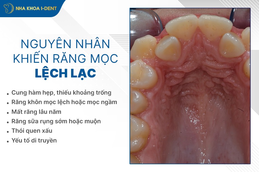 niềng răng lệch lạc mất bao lâu