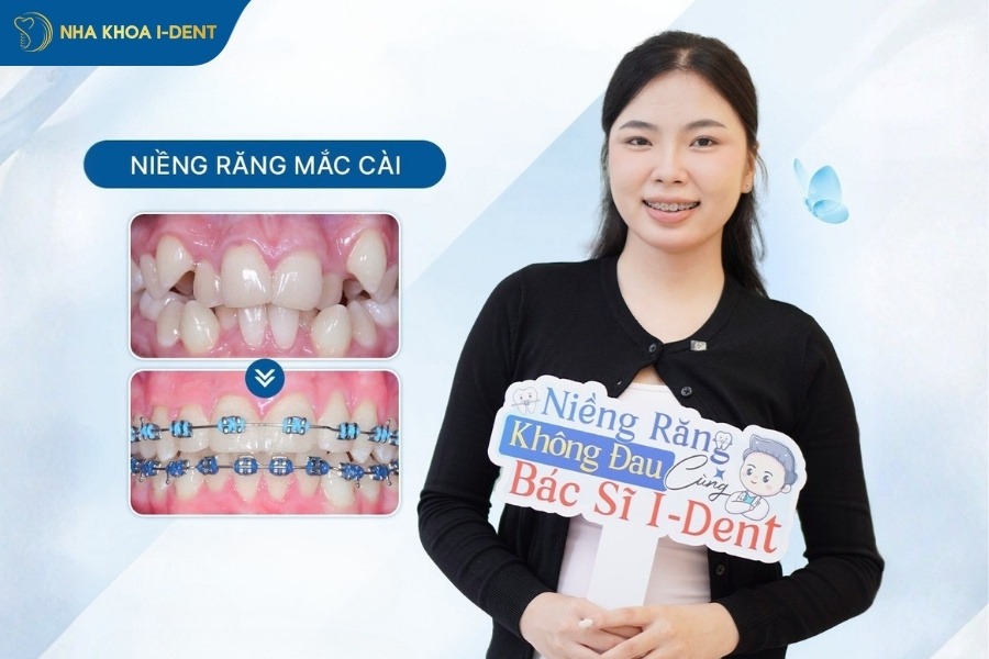 niềng răng loại nào rẻ nhất
