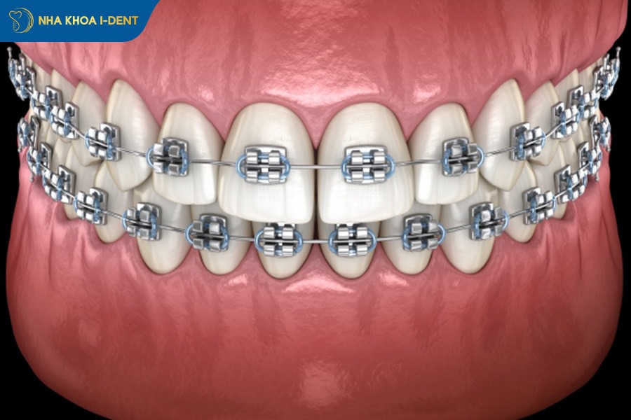 niềng răng mắc cài sứ và kim loại