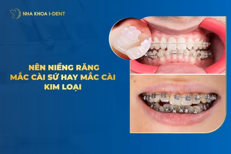 Niềng Răng Mắc Cài Sứ Và Kim Loại Nên Chọn Loại Nào?