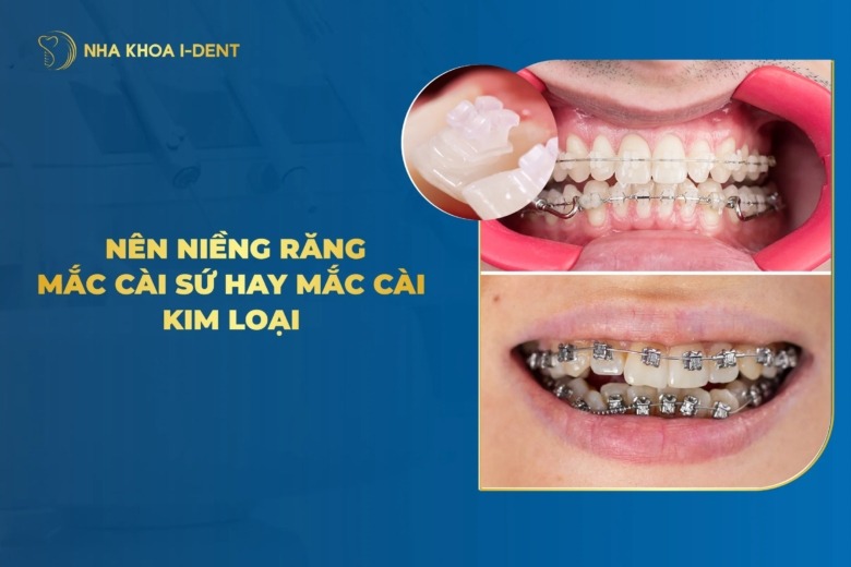 Nên Niềng Răng Mắc Cài Sứ Hay Mắc Cài Kim Loại?