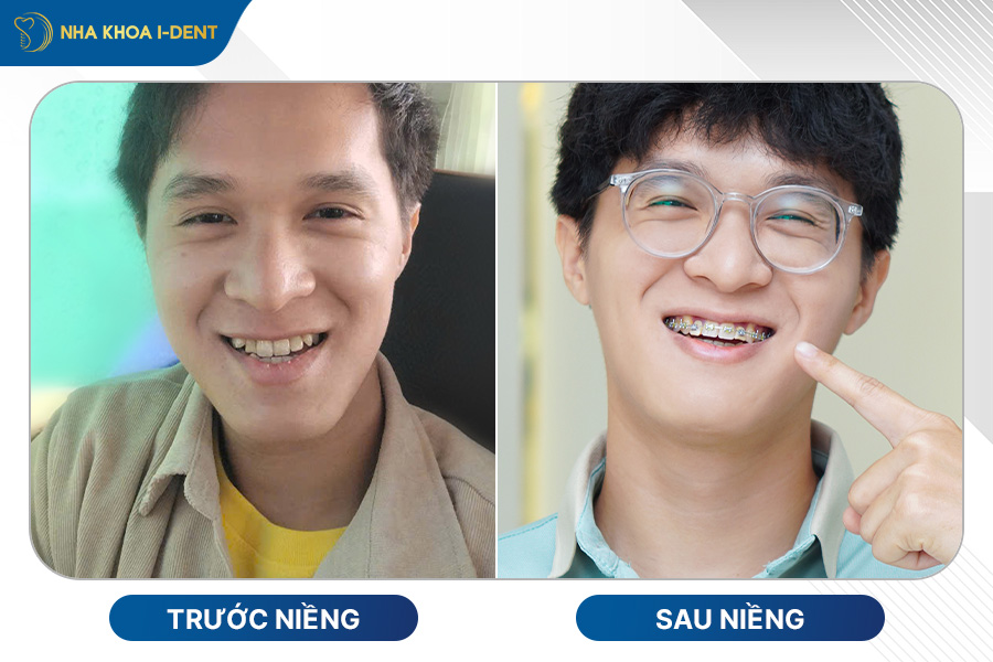 niềng răng mọc lệch