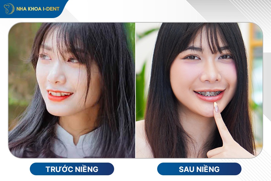 niềng răng mọc lệch