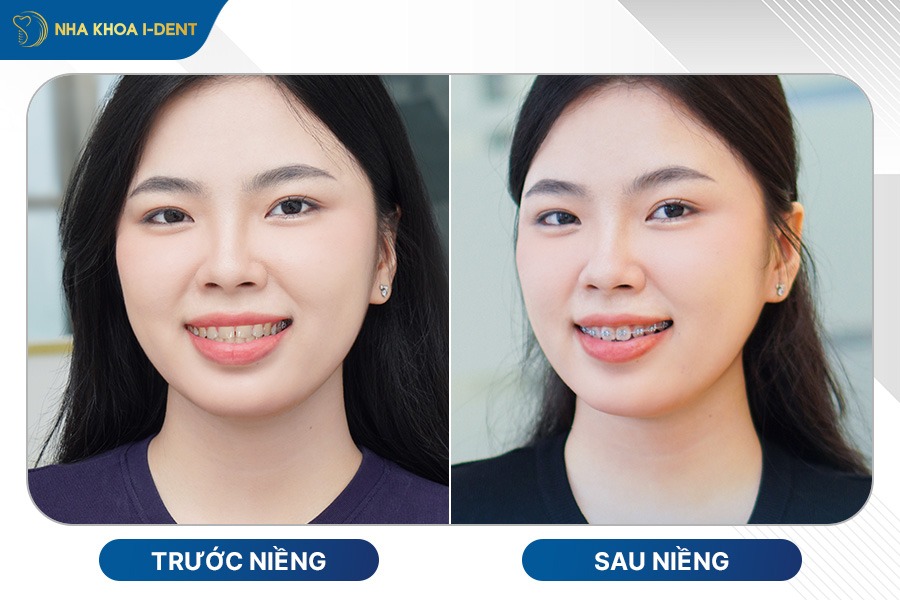 niềng răng lệch lạc