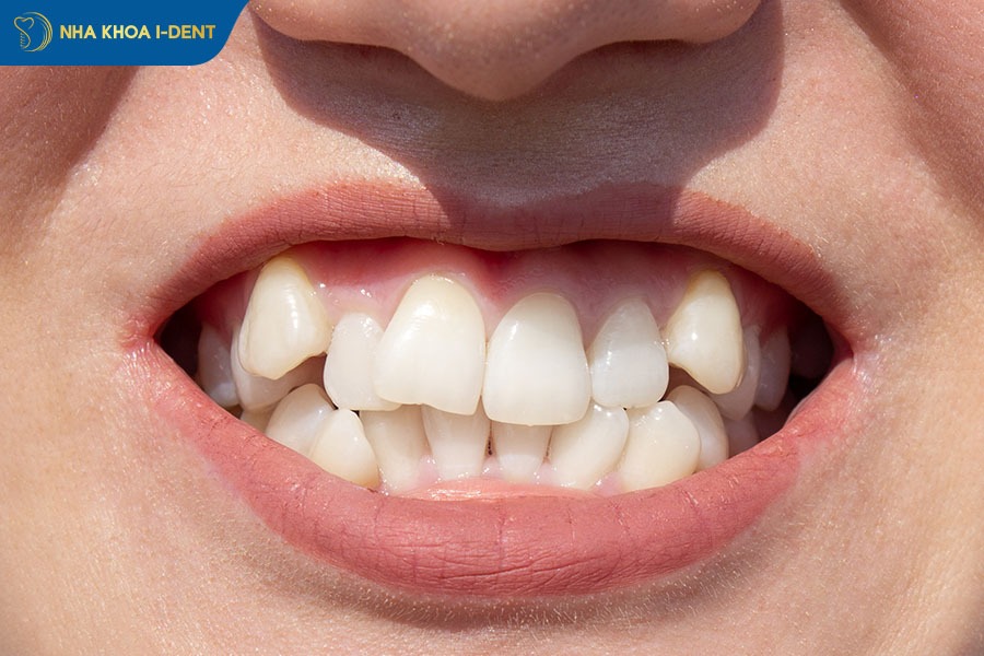 niềng răng mọc lệch