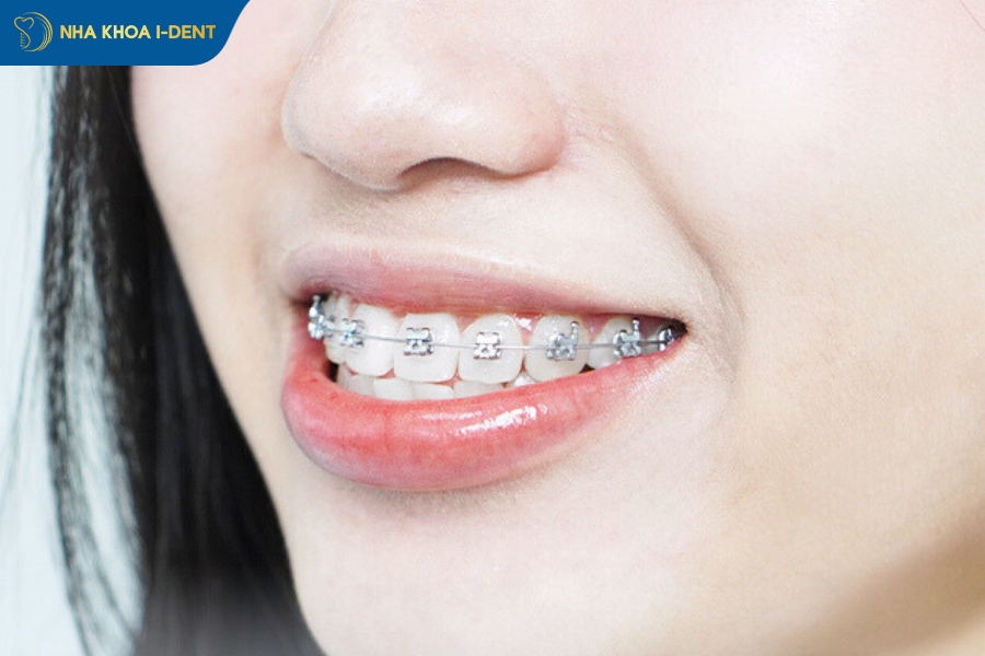 niềng răng có hết móm không