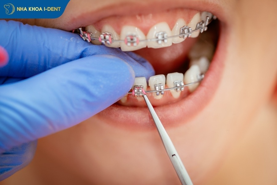 niềng răng tháo sớm được không