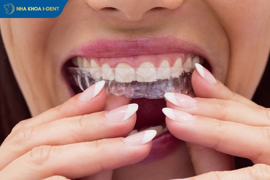 niềng răng trong suốt mất bao lâu