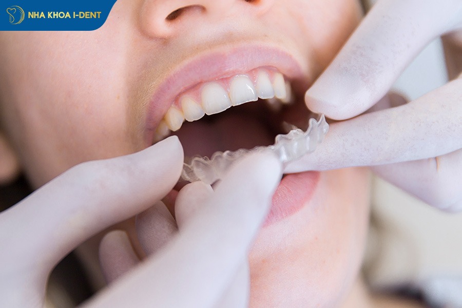 niềng răng trong suốt clear aligner