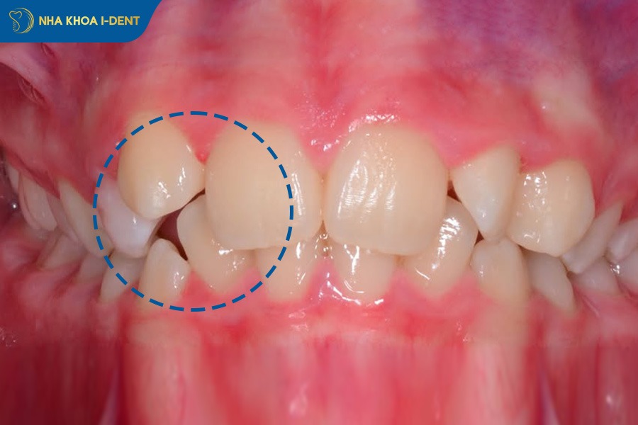 Nếu răng chỉ bị lệch nhẹ thì thời gian niềng răng trong suốt sẽ nhanh.