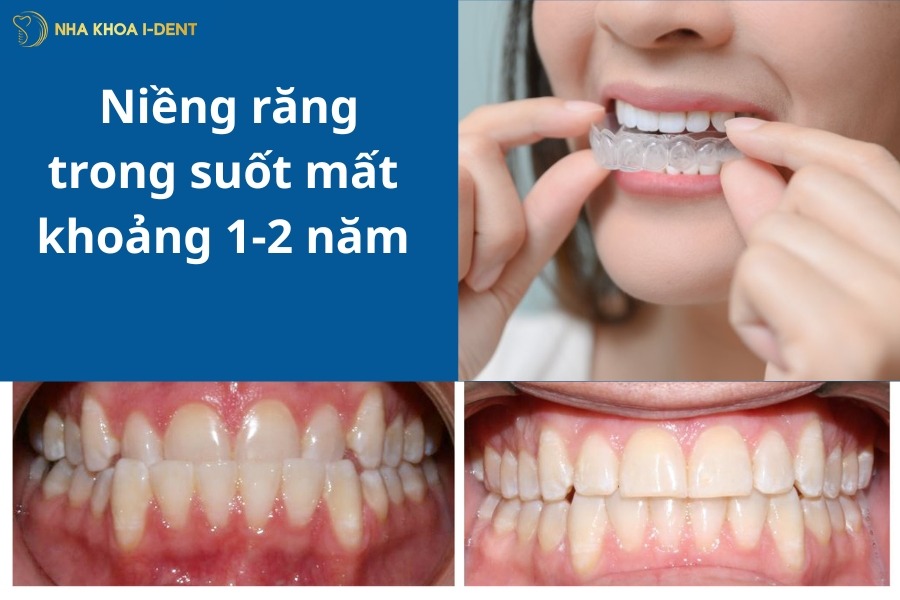 niềng răng trong suốt mất bao lâu