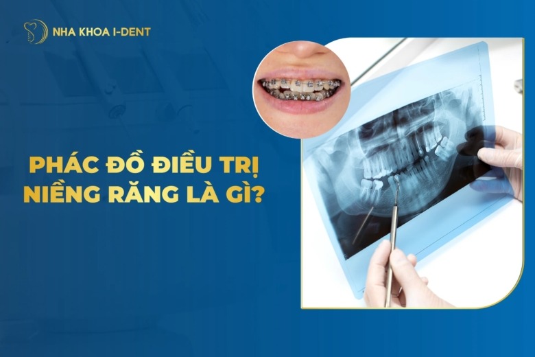 Phác Đồ Điều Trị Niềng Răng Là Gì? Các Bước Chi Tiết