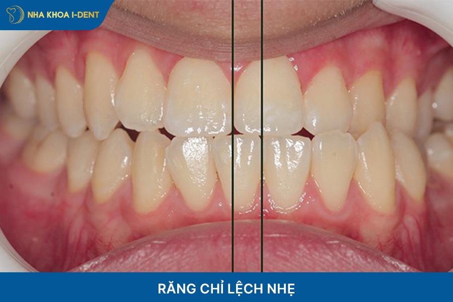 Răng chỉ bị lệch nhẹ thì không cần nhổ răng khi niềng trong suốt