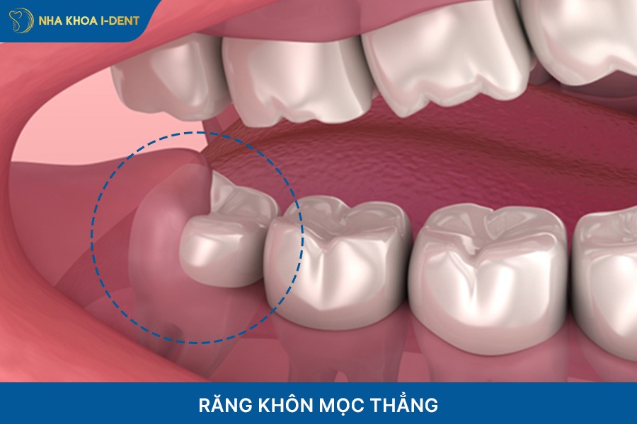 Răng khôn mọc thẳng không cần nhổ răng khi niềng trong suốt