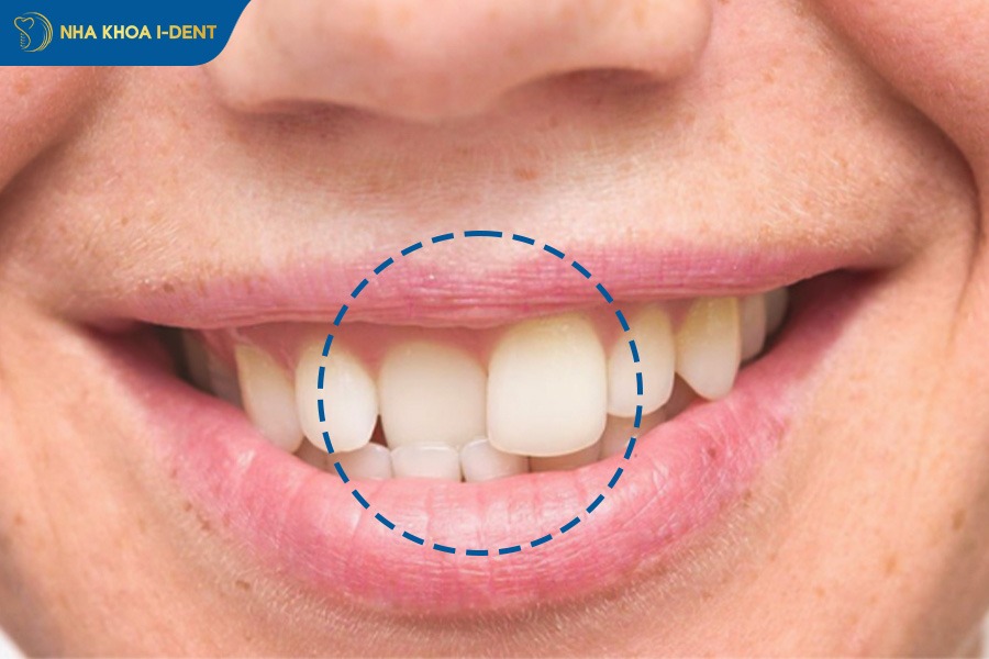 Trường hợp răng sai lệch nặng sẽ đau hơn răng chỉ bị lệch nhẹ.