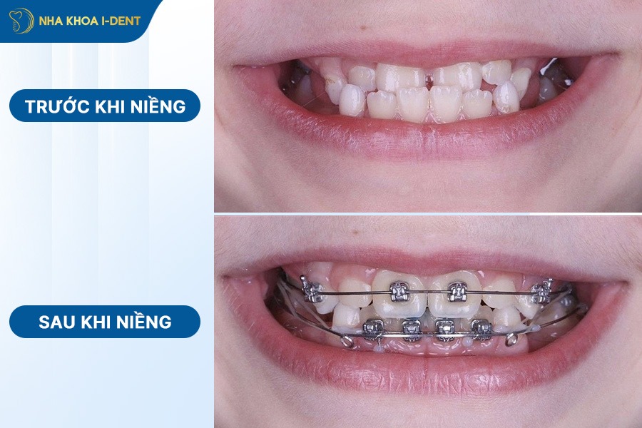 răng sau khi niềng